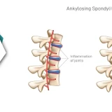 Ankylosing Spondylitis | How Physiotherapy Relieves Pain And Enhances Mobility?