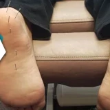 Dry Needling For Plantar Fasciitis | How It Can Help In The Management Of Heel Pain?