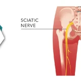 Find Relief From Sciatica In South Delhi | Experience Healing With Physiotherapy At Cb Physiotherapy