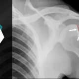 Hill-sachs Lesion | How Physiotherapy Can Reduce The Risk Of Recurrent Shoulder Dislocations?