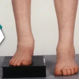 Limb Length Discrepancy | Understanding Its Impact And The Role Of Physiotherapy In Management