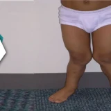 Managing Genu Valgus In Children | Strengthening And Stretching Of Stiff Muscles For Improved Growth