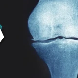 Managing Knee Pain | Understanding Osteophytic Changes And The Role Of Physiotherapy