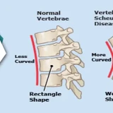 Managing Scheuermann's Disease | How Physiotherapy Can Improve Spine Health And Posture?