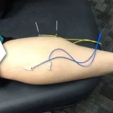 Role Of Electrical Dry Needling In Physiotherapy | A Modern Approach To Pain Management And Recovery