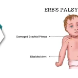 Role Of Electrical Stimulation In Managing Erb's Palsy | Enhancing Recovery And Functionality