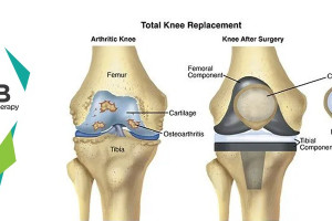 12 Best Postoperative Exercises For Knee Replacement
