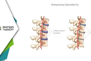 Ankylosing Spondylitis | How Physiotherapy Relieves Pain And Enhances Mobility?