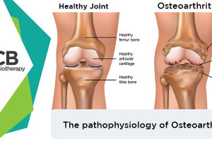 How Osteoarthritis Affects Our Body? Its Pathophysiology