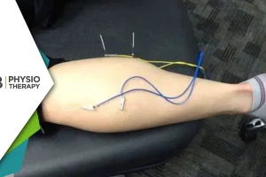 Role Of Electrical Dry Needling In Physiotherapy | A Modern Approach To Pain Management And Recovery