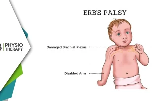 Role Of Electrical Stimulation In Managing Erb's Palsy | Enhancing Recovery And Functionality