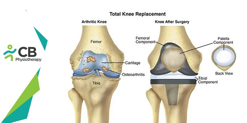 12 Best Postoperative Exercises For Knee Replacement