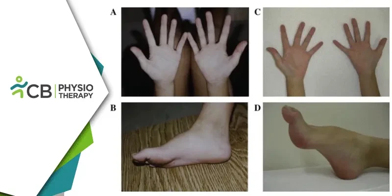 Charcot-marie-tooth Disease | The Essential Role Of Physiotherapy In Managing Cmt