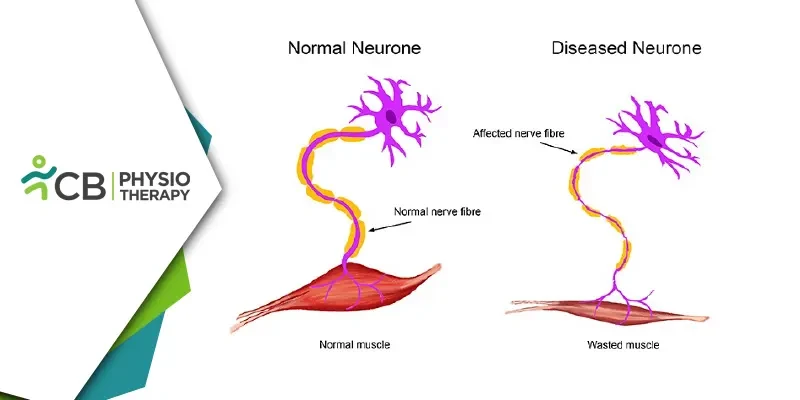 जीवन को सशक्त बनाना | मोटर न्यूरॉन रोग (एमएनडी) के प्रबंधन में फिजियोथेरेपी की महत्वपूर्ण भूमिका