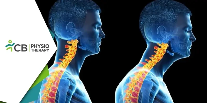 Forward Head Posture | Understanding Its Impact On Neck And Shoulder Pain And How Physiotherapy Can Provide Relief?