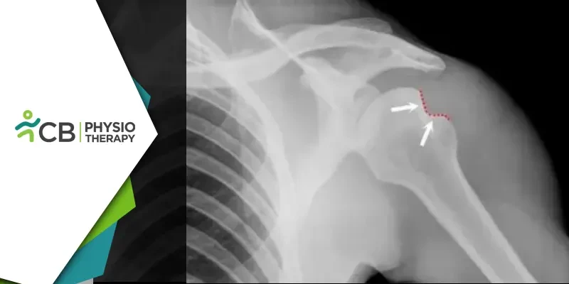 Hill-sachs Lesion | How Physiotherapy Can Reduce The Risk Of Recurrent Shoulder Dislocations?