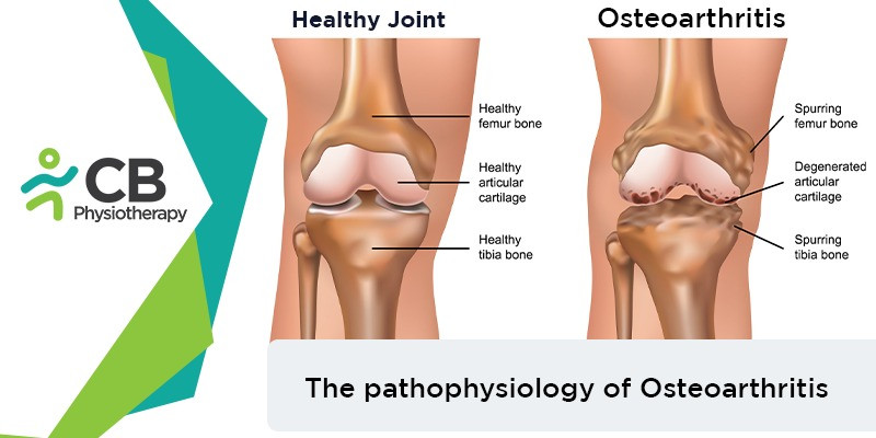 How Osteoarthritis Affects Our Body? Its Pathophysiology