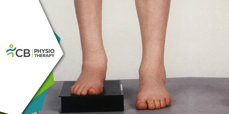 Limb Length Discrepancy | Understanding Its Impact And The Role Of Physiotherapy In Management