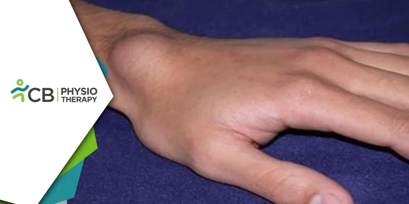 Managing Ganglion Cysts | Physiotherapy's Vital Role In Pain Relief And Function Improvement