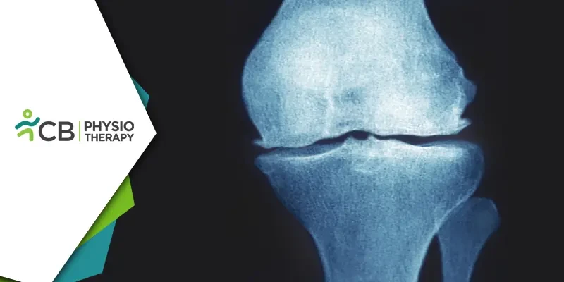 Managing Knee Pain | Understanding Osteophytic Changes And The Role Of Physiotherapy