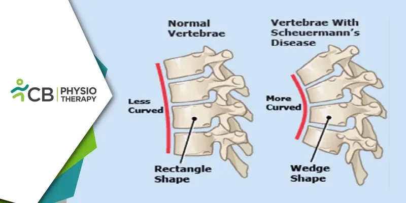 Managing Scheuermann's Disease | How Physiotherapy Can Improve Spine Health And Posture?