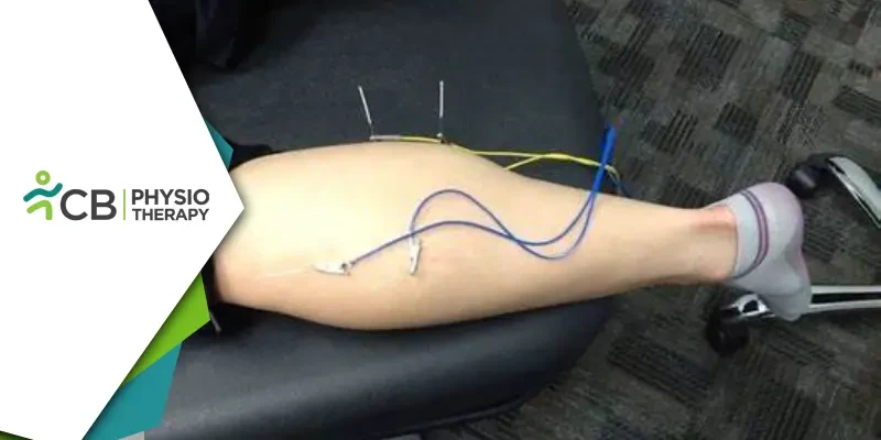 Role Of Electrical Dry Needling In Physiotherapy | A Modern Approach To Pain Management And Recovery