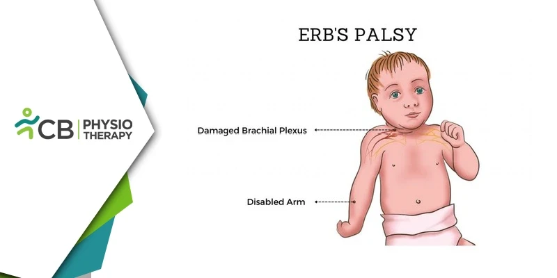 Role Of Electrical Stimulation In Managing Erb's Palsy | Enhancing Recovery And Functionality