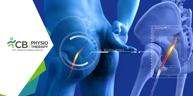 Sciatica, How Physiotherapy Management helps in Relieving the Sciatic  Nerve Pain?