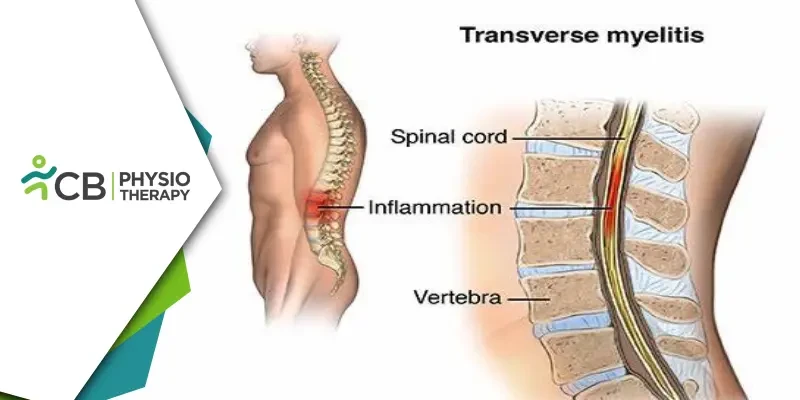 Transverse Myelitis | Managing Muscle Weakness And Regaining Mobility Through Physiotherapy
