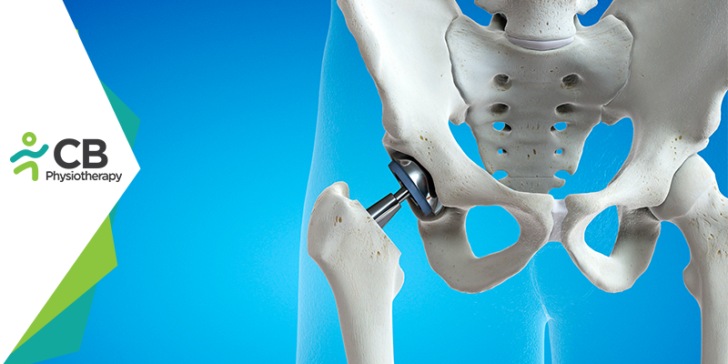What Not To Do After Hip Replacement Surgery?