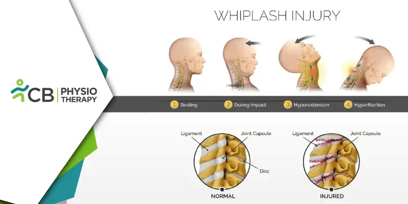 Whiplash Injury | How Physiotherapy Aids In Effective Treatment And Recovery