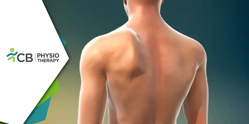 Winged Scapula | The Vital Role Of Physiotherapy In Effective Management