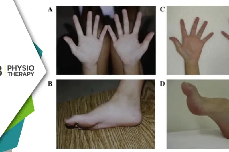 Charcot-marie-tooth Disease | The Essential Role Of Physiotherapy In Managing Cmt