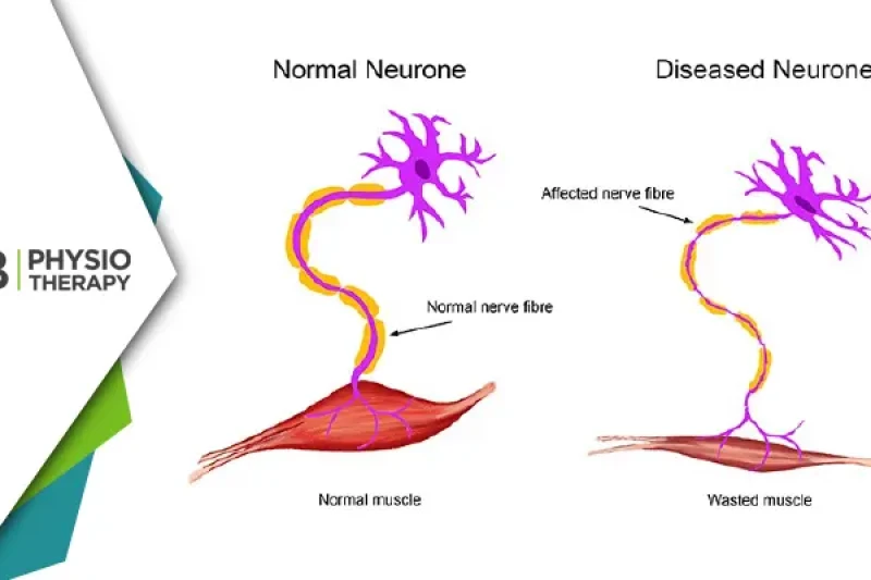 जीवन को सशक्त बनाना | मोटर न्यूरॉन रोग (एमएनडी) के प्रबंधन में फिजियोथेरेपी की महत्वपूर्ण भूमिका
