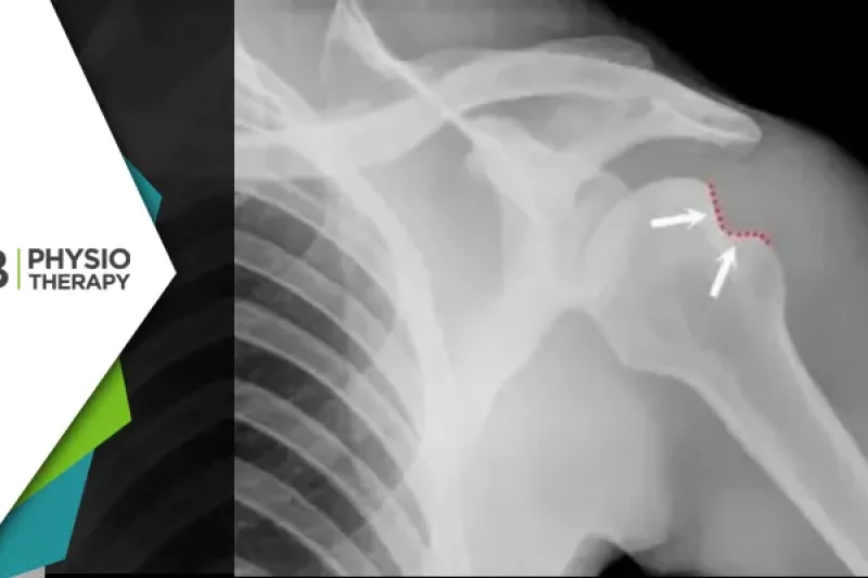 Hill-sachs Lesion | How Physiotherapy Can Reduce The Risk Of Recurrent Shoulder Dislocations?