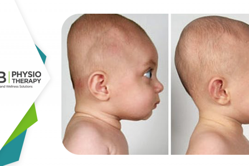 Infant Head Shape | How Physiotherapy Can Help Attain A Round Head?