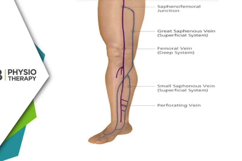 Intermittent Claudication | The Role Of Physiotherapy In Managing Peripheral Artery Disease