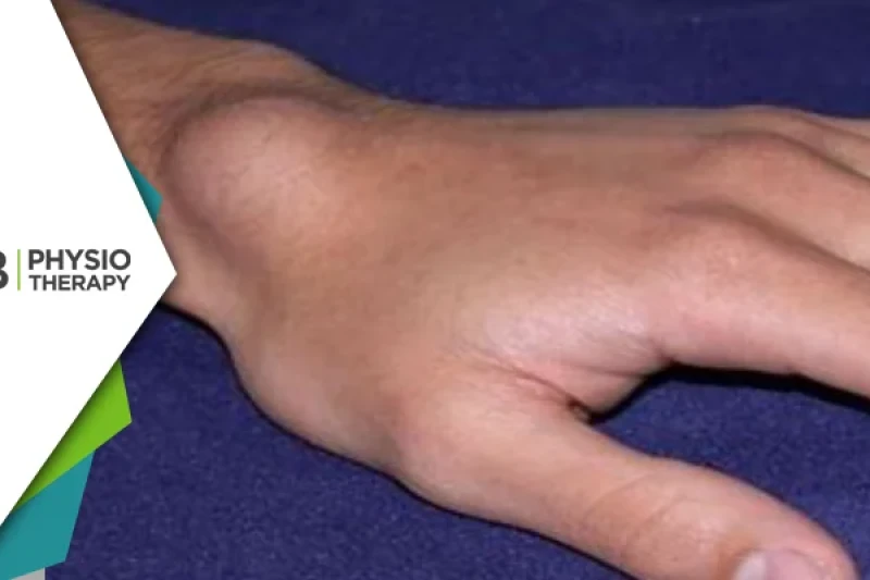 Managing Ganglion Cysts | Physiotherapy's Vital Role In Pain Relief And Function Improvement