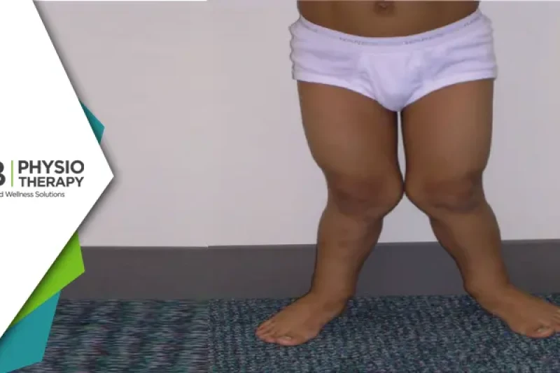 Managing Genu Valgus In Children | Strengthening And Stretching Of Stiff Muscles For Improved Growth
