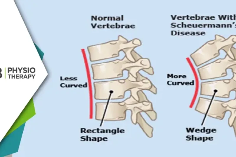 Managing Scheuermann's Disease | How Physiotherapy Can Improve Spine Health And Posture?