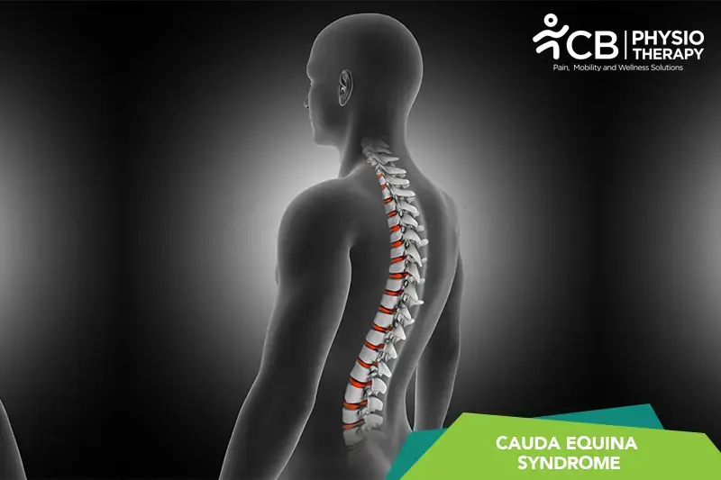 Cauda Equina Syndrome