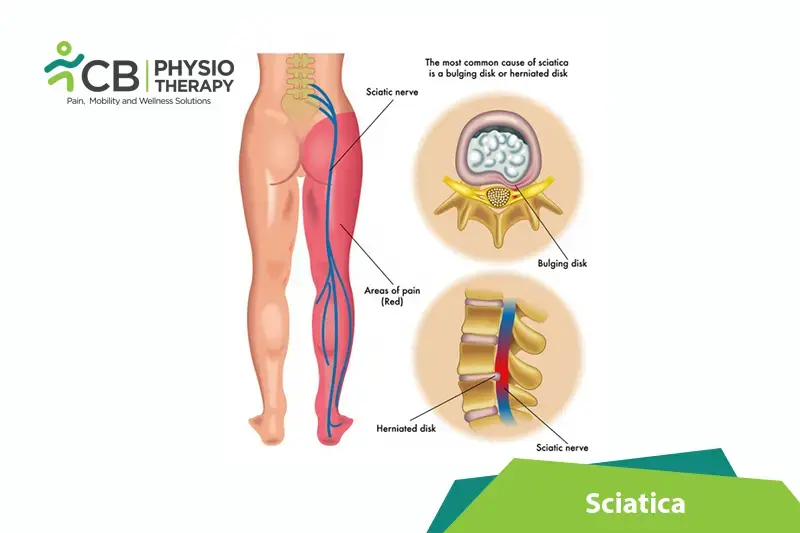 Sciatica