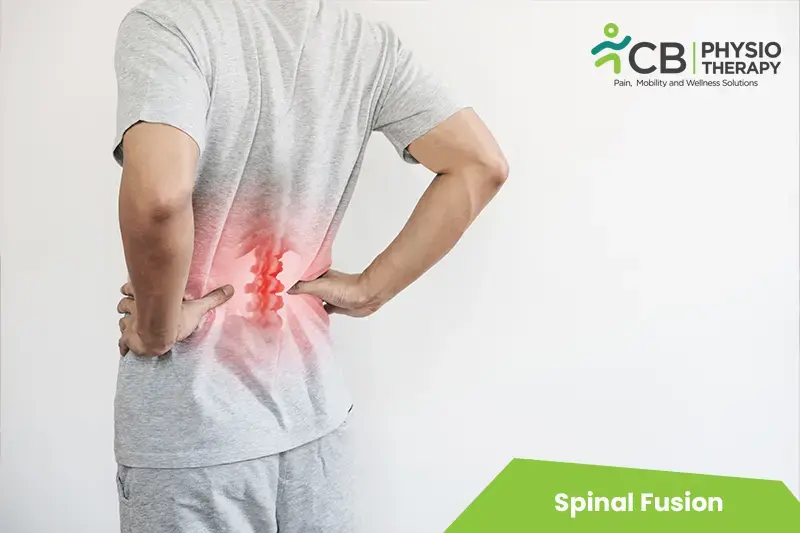 Spinal Fusion