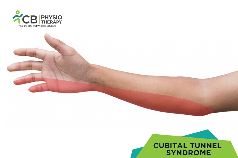 Cubital Tunnel Syndrome