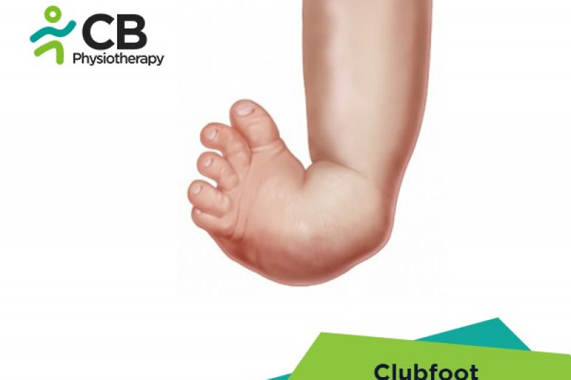 Clubfoot Or Congenital Talipes Equinovarus Or Ctev