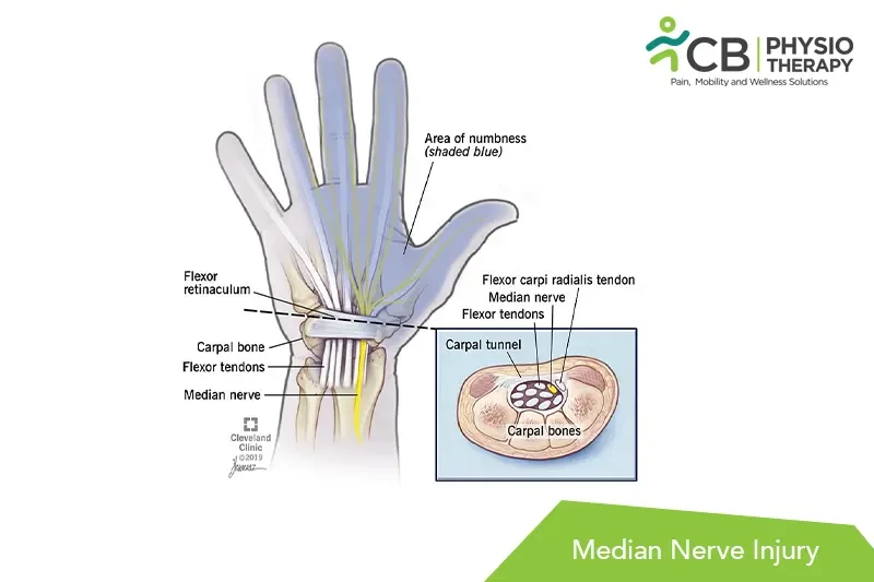 median-nerve-injury.webp
