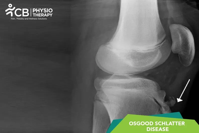 osgood-schlatter-disease.webp