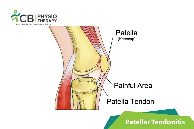 patellar-tendonitis.webp