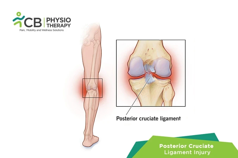 posterior-cruciate-ligament-pcl-injury.webp