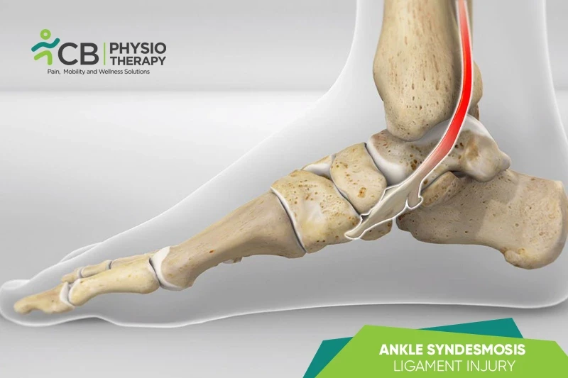 Posterior Tibial Tendon Dysfunction (pttd)